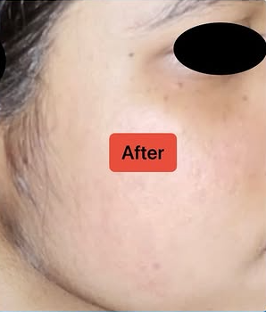 Hair Loss After PRP
